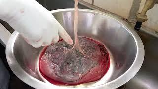 Placenta examination