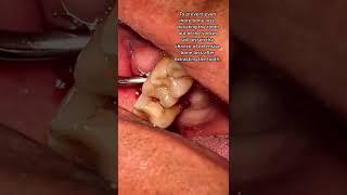 Broken Molar (Tooth #3) Extraction Using Tooth Elevator | In Office to Hands On Dental Training