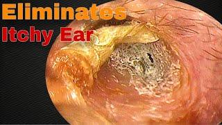 The Itching Stopped after Removing Earwax | Doctor Anh