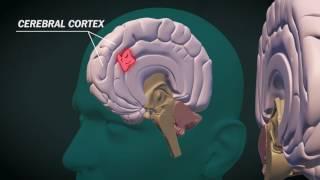 What is glioblastoma?