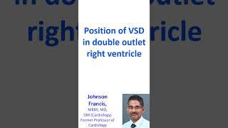Position of VSD in double outlet right ventricle