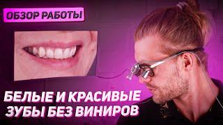 Как сделать зубы белыми и красивыми без виниров?