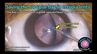 CataractCoach™ 2328: saving the capsular bag in ectopia lentis