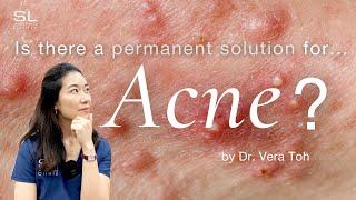 Can Acne be healed permanently?