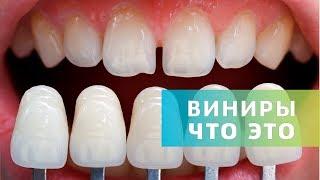 Виниры. Зачем, когда и где устанавливать | Что такое виниры | Дентал ТВ