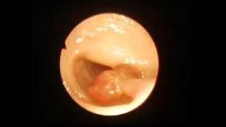 Colonoscopy polyp on thin base.