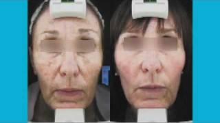 How Cosmetic Laser Treatment Remove Sun Spots & Wrinkles