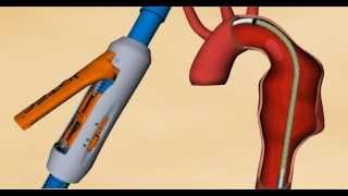 Simulación Endoprotesis Toracica E-Vita de Jotec