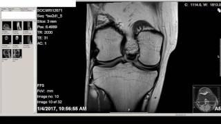 MRI of 18 year old boy's right knee 1 year after OATS surgery