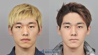 Guys Transform Into a Handsome Man, Plastic Surgery Korea Before and After