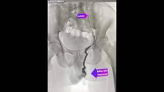 Varicocele Embolisation Angiography (venogram) of left gonadal vein in a man suffering from