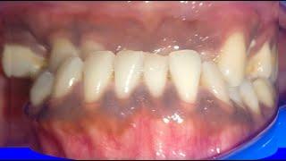 Orthodontics before and after! Invisalign Treatment: Case by Dr Vandana Katyal, Orthodontist