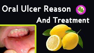 Oral Ulcer Treatment - Mouth Ulcer Ka Ilaj Ghar Main