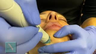 Hydrafacial at The Naderi Center