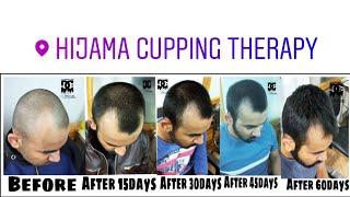 Hair Receeding Growth Treatment By Hijama Cupping Therapy