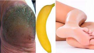 ONE BANANA IS WHAT YOU NEED FOR CRACKED FEET