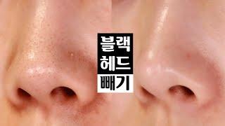 SUB) 남자친구랑 집에서 간단하게 블랙헤드 없애는법 (코 블랙헤드 빼기) Black head remover⎮ 미소정 SmileJ