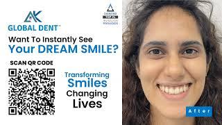 Smile Transformations With Invisalign | Brace-Free, Wire-Free, & Stress-Free | AK Global Dent