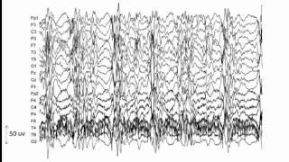 Pharmacologically induced coma: Neurophysiology and closed-loop control