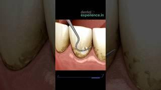 Tooth Cleaning | Teeth Scaling I stain or Tartar Removal cost in Kochi, Kerala | Dentalexperience.in