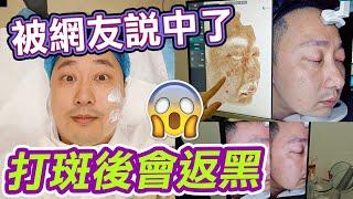 被網友說中了，會反黑｜第三個月有反黑情況｜最新實況｜老人斑曬班｜超皮秒｜美白修復補水｜去斑修復維養｜雞尾酒色素管理激光｜醫美｜袪斑｜脂溢性角化斑｜老人斑｜利奧