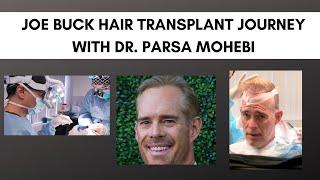 Joe Buck Hair Transplant with Dr. Parsa Mohebi