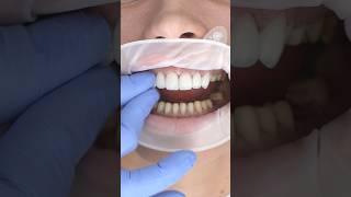 FIX Your Smile Imperfections with Veneers!