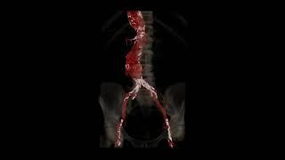 aortic aneursym