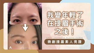 【微創提眉術後素人見證】我變年輕了在提眉手術之後！| 璞美整形外科醫美診所