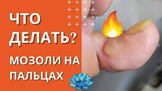 Стержневая мозоль на пальце ноги. Что делать с мозолью.