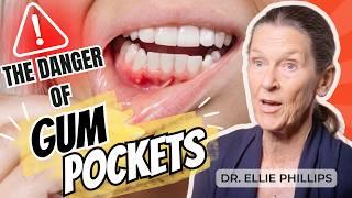 Heal Gum Pockets & Eliminate Deep Cleanings