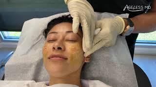 Check out Dr. Tsay performing this PDO thread lift - Ageless MD