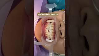 Braces installation process | Proses pemasangan braces