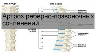 Артроз реберно-позвоночных сочленений