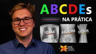 Aplicando os ABCDEs na PRÁTICA - Tórax, Abdome e Osso