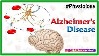 Alzheimer's disease : Etiology, Pathophysiology, Signs and symptoms, Diagnosis and Treatment