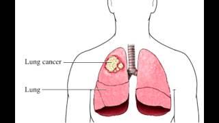 Lung Cancer - Overview