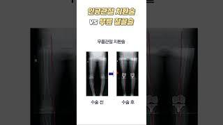 [1분 건강백서] 인공관절치환술 vs 무릎절골술 │일산백병원 정형외과 나경욱 교수