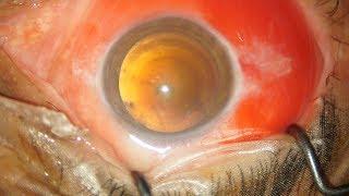 Superhard Brown Cataract with 32.0 mm Axial Length ! (Grab a cup of Coffee and Watch)