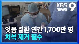 ‘양치로는 부족’ 잇몸병 환자 1,700만…치석 제거 필수 / KBS  2022.06.12.