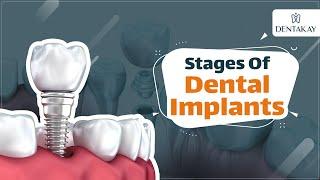 Dentakay | Stages Of Dental Implants