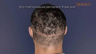 What is Follicular Unit Extraction or FUE Hair Transplant