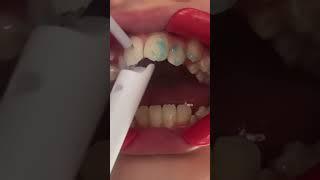 LIGHTFORCE BRACES‼️#shullmanorthodontics #reels