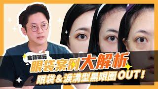 眼袋案例大解析！眼袋＆淚溝型黑眼圈OUT｜周杰醫師