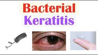 Bacterial Keratitis (Eye Infection From Contact Lenses) | Causes, Symptoms, Diagnosis, Treatment