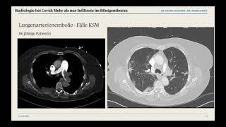 Radiologie bei Covid - Mehr als nur Infiltrate im Röntgenthorax