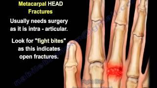 Metacarpal Fractures - Everything You Need To Know - Dr. Nabil Ebraheim