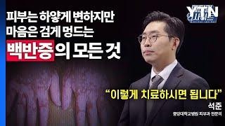 [메디컬 인사이트 63회] 피부과 전문의가 알려주는 '백반증'의 증상과 치료법 / YTN