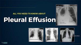 Pleural Effusion - Types, Causes, Evaluation & Management (All You Need To Know For Exam)