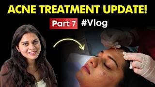 देखिये कैसे होता है Acne Treatment! | Acne Treatment Update 2025! #Vlog | Clear Skin, Pune